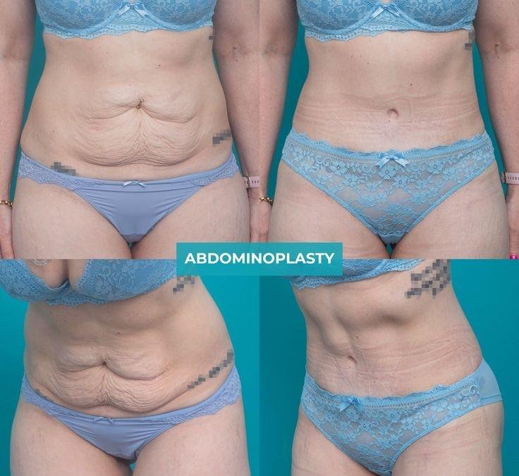 Prime Med Hub - Abdominoplastyka