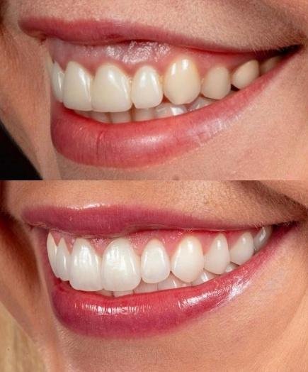 Prime Med Hub Hollywood Smile