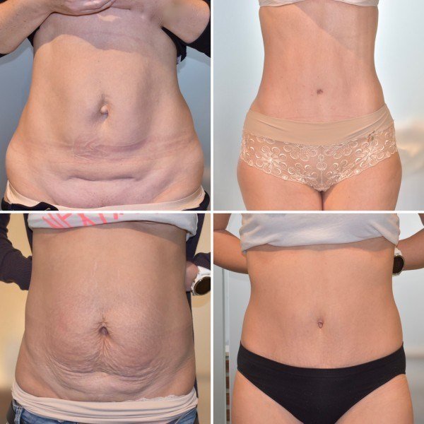 Prime Med Hub - Abdominoplastyka