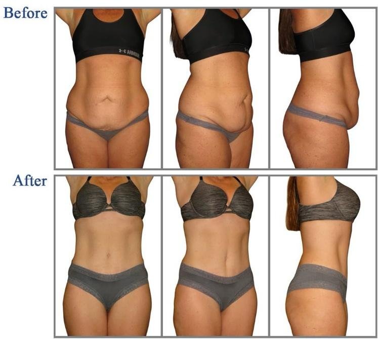 Prime Med Hub liposukcja