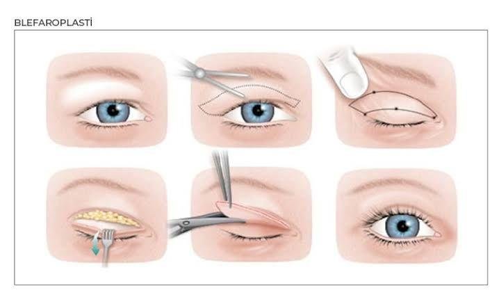 Prime Med Hub - Blefaroplastyka